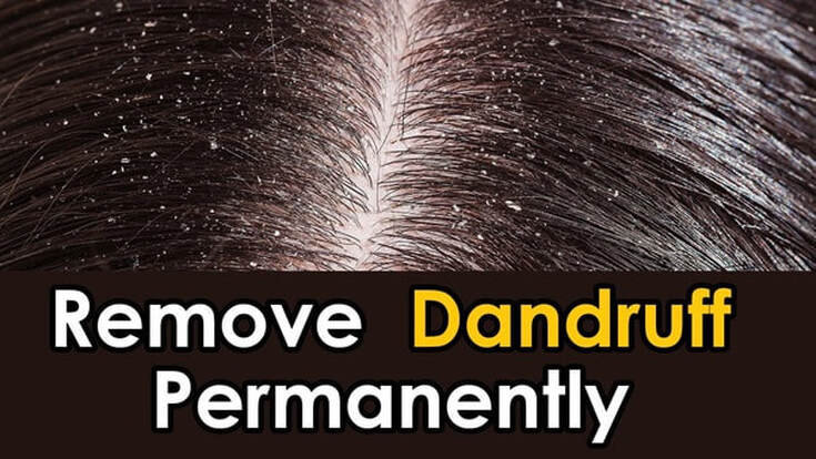 How to Get Rid of Dandruff Fast Naturally?